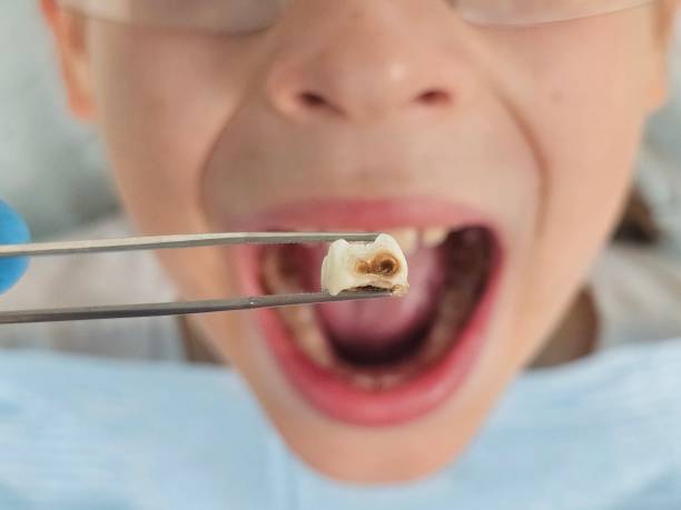 Best Emergency Dental Care for Broken or Chipped Teeth in Premont, TX